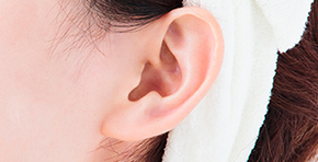 耳の整形手術